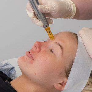 Skin Needling + Exosome Therapy